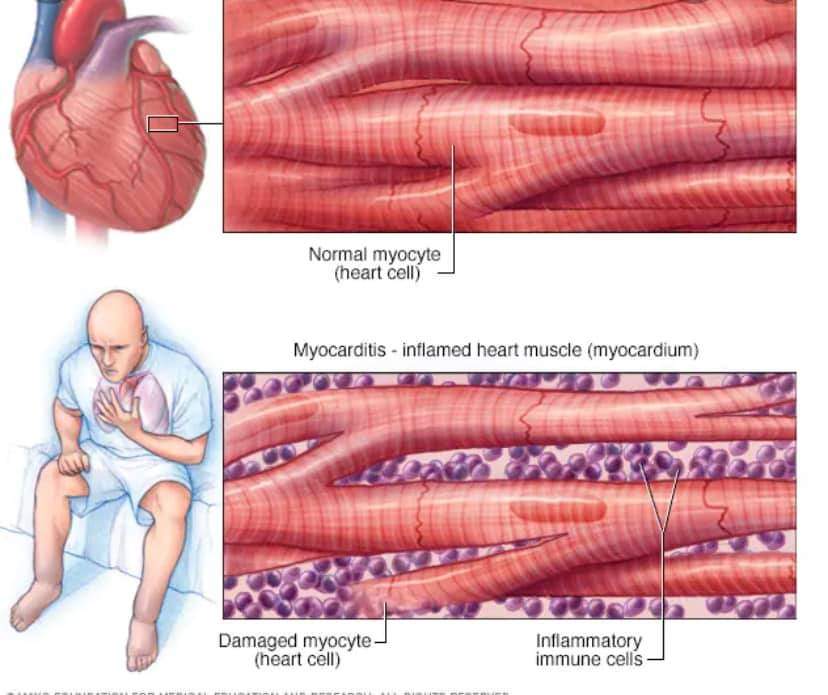 Myocarditis Radang Otot Jantung